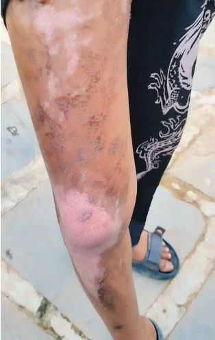 रसोई में गर्म दाल से झुलसे 2 छात्र, परिजनों ने की कार्रवाई की मांग image